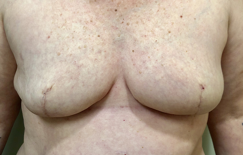  Autologus Minimal Invasive Reconstruction 