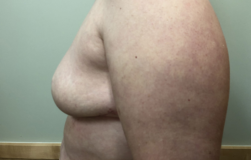  Autologus Minimal Invasive Reconstruction 